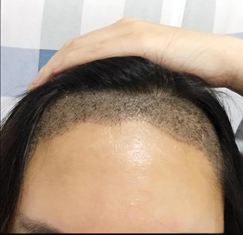 北京植发5万，县城8000：差价背后藏着多少猫腻？