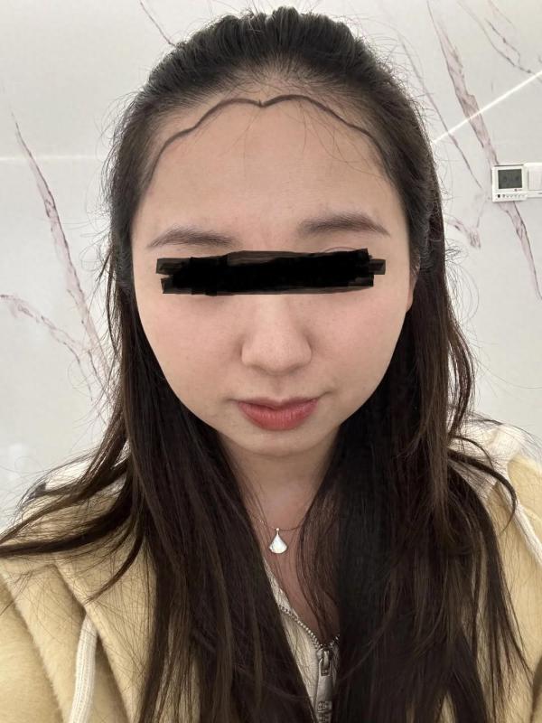 上海的小姐姐分享自己植发的亲身经历，真是太可爱了