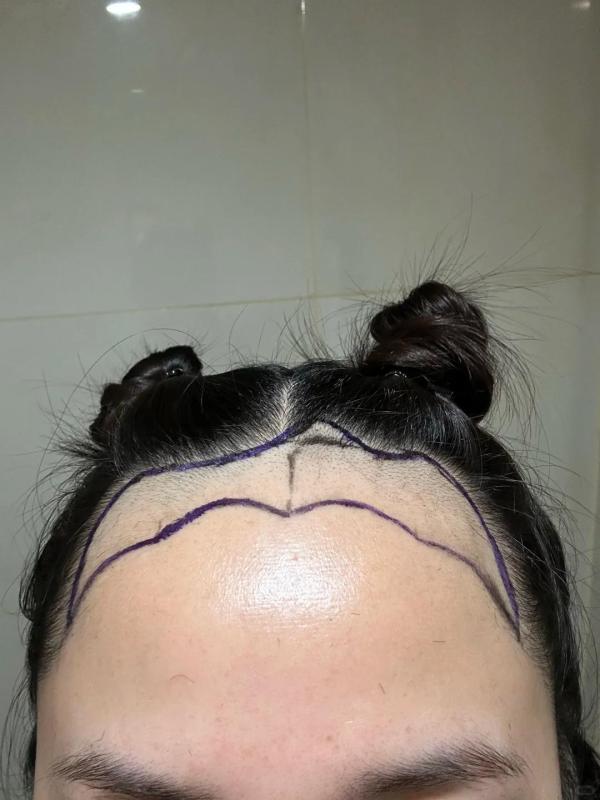 上海的小姐姐分享自己植发的亲身经历，真是太可爱了