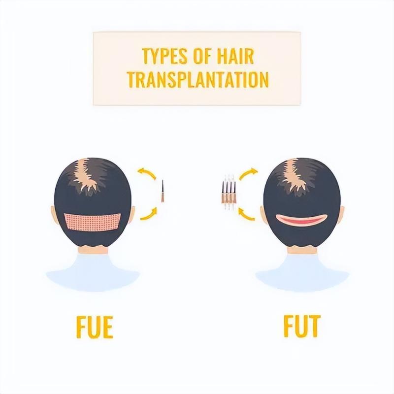盘点植发哪些坑!1-3万预算我差点被套路成冤大头