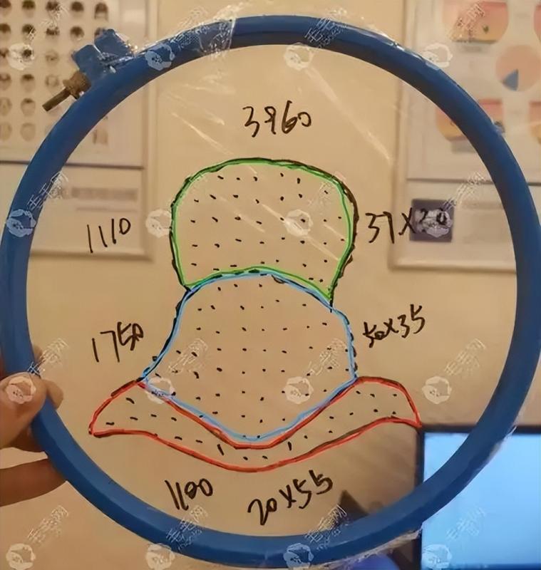 盘点植发哪些坑!1-3万预算我差点被套路成冤大头