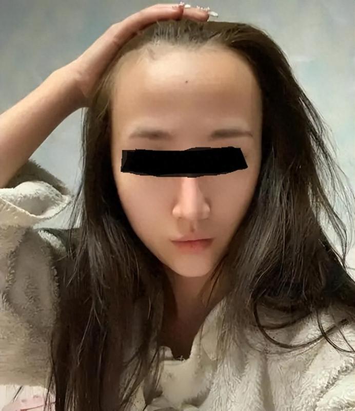 我攒钱去植发了:头发是90后最后的尊严