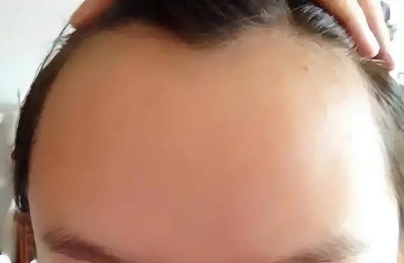 我攒钱去植发了:头发是90后最后的尊严