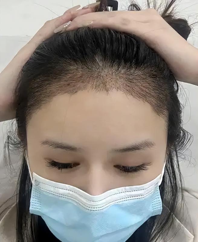 我攒钱去植发了:头发是90后最后的尊严