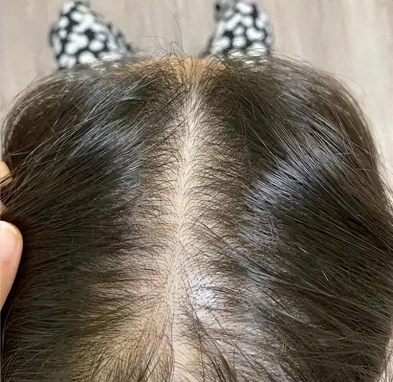 月薪8000发缝宽，我的2万块植发自救指南！