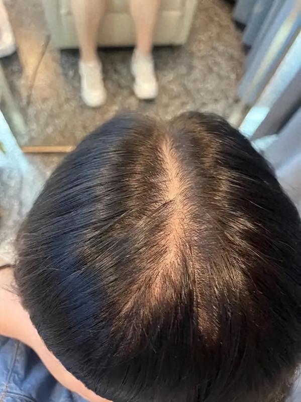 发缝稀疏自救指南：如何让种植头发和原生发无缝衔接！