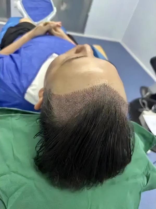 不剃发植发值得多花2万吗？我的性价比账本！