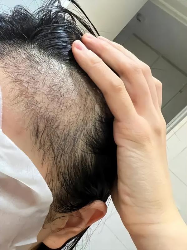 不剃发植发值得多花2万吗？我的性价比账本！