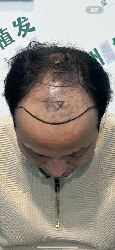 花近2万植发为何成了“头顶赌局”？