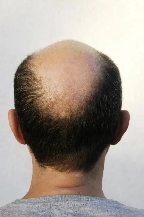 男性为什么更容易脱发?雄秃的科学真相与残酷物语