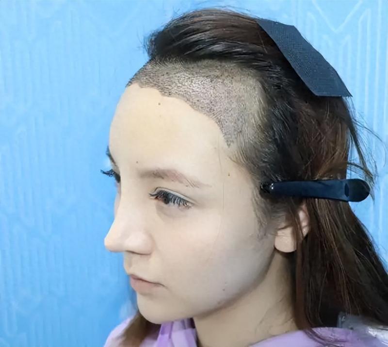 植发后永不脱落？医生不敢说的3个真相