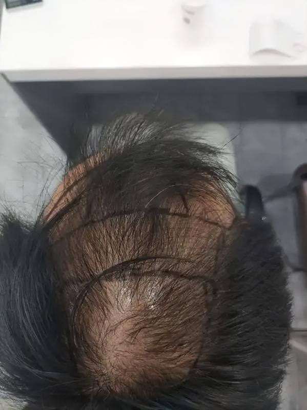 植发后永不脱落？医生不敢说的3个真相