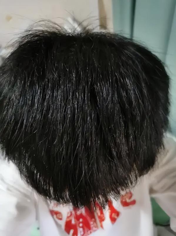 植发后永不脱落？医生不敢说的3个真相