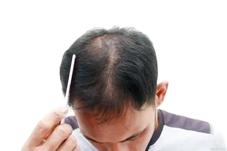 头顶荒漠化:中国男性的发际线保卫战为何如此惨烈?