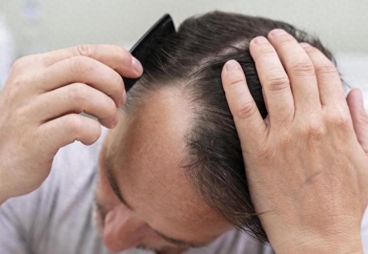 脱发是大病的苗头？经常脱发的人，或是体内4种疾病