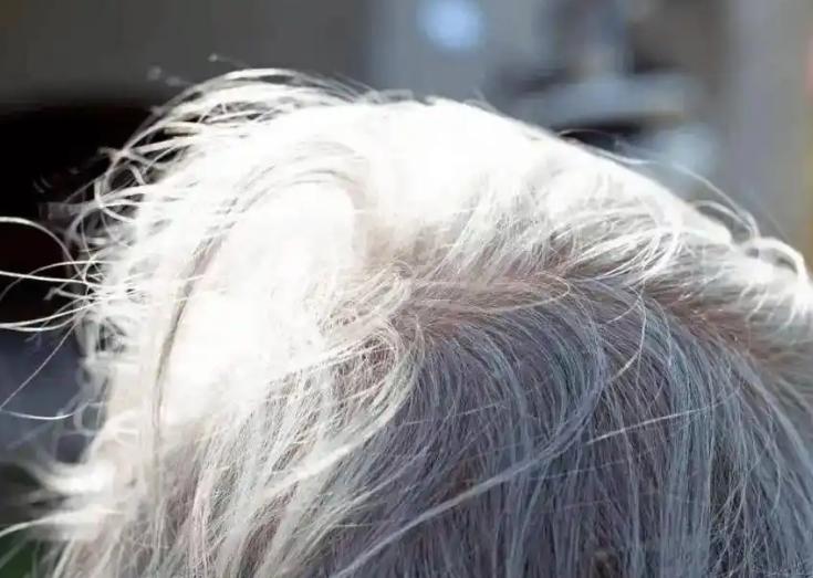 脱发是大病的苗头？经常脱发的人，或是体内4种疾病
