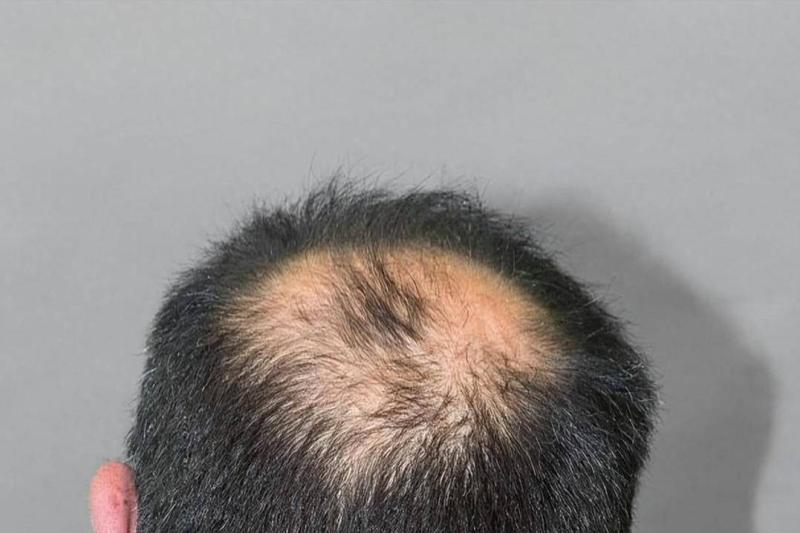 脱发掉发太严重？中医妙招来帮你，轻松养发不再烦恼