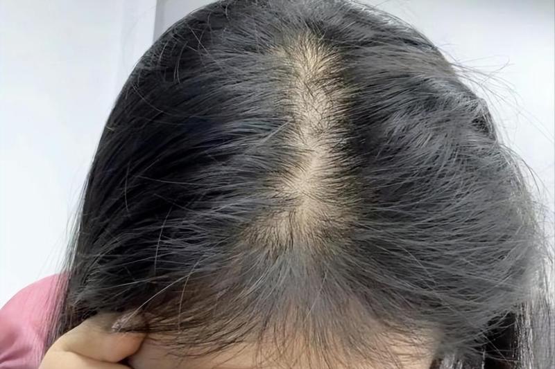 脱发掉发太严重？中医妙招来帮你，轻松养发不再烦恼