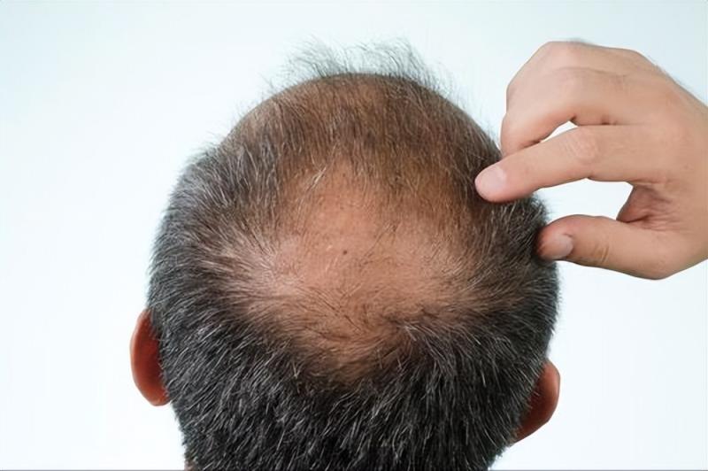 脱发掉发太严重？中医妙招来帮你，轻松养发不再烦恼