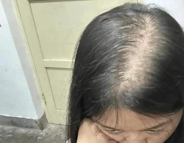 身体缺什么会大把掉头发？原因告诉您秀发自己长出来