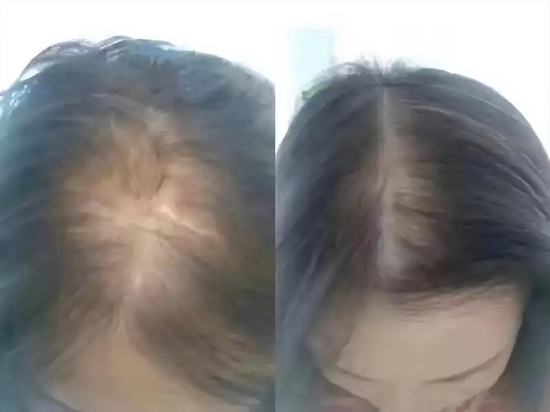 身体缺什么会大把掉头发？原因告诉您秀发自己长出来