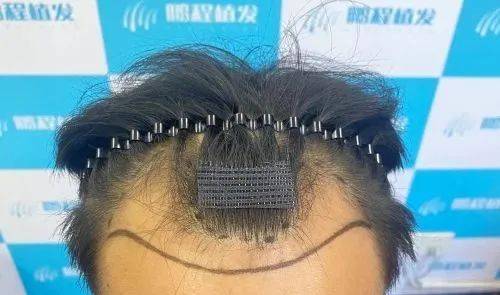 做了植发没效果？植发也有滞后性！深圳鹏程植发在线科普！