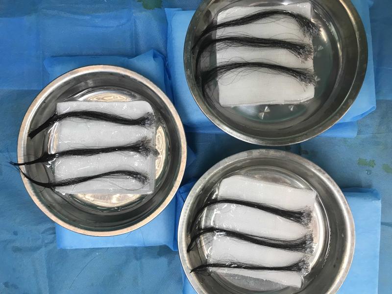 郑州中植植发医院NCT UP+不剃发长发种植技术新突破