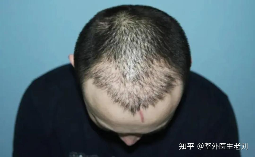 植发1元变上万元，植发真的靠谱吗？