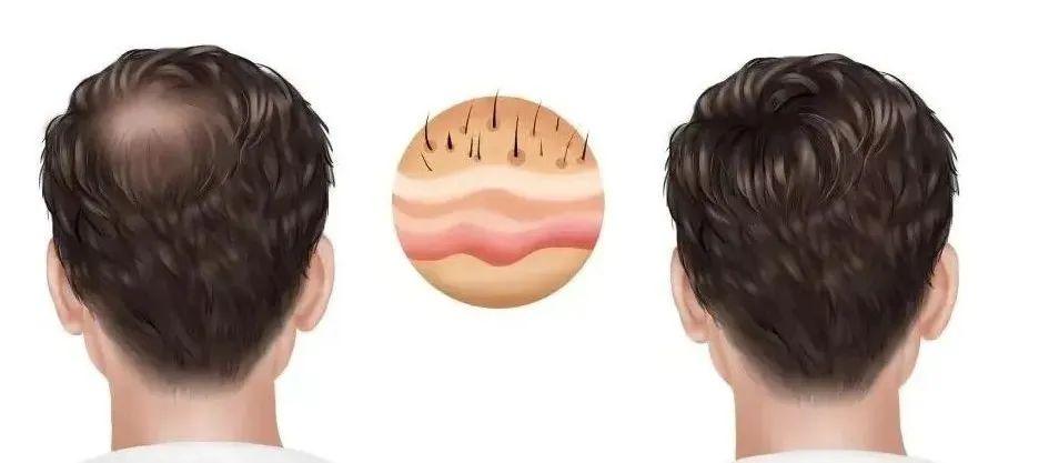 发友问：一人能做几次植发？二次种植或多次种植可以吗？