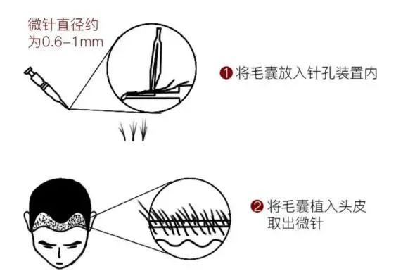 未老先秃年轻人涌入植发门诊，医生：往往是因为这些原因