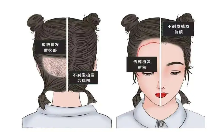 植发后多久见效？如何保持植发效果