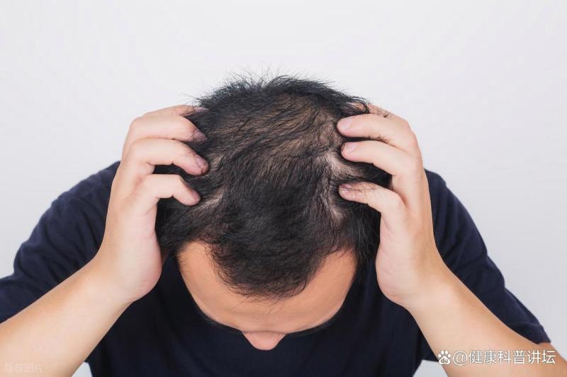 频繁掉发干脆剃光头养发？有人真这么干了，医生提醒细节
