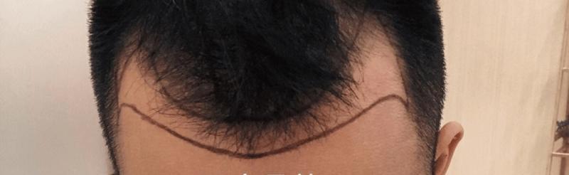 植发后多久能见效果？术后1天到1年完整恢复时间表