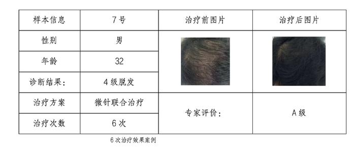 传统植发将被颠覆，微针疗法改善脱发获得临床实证