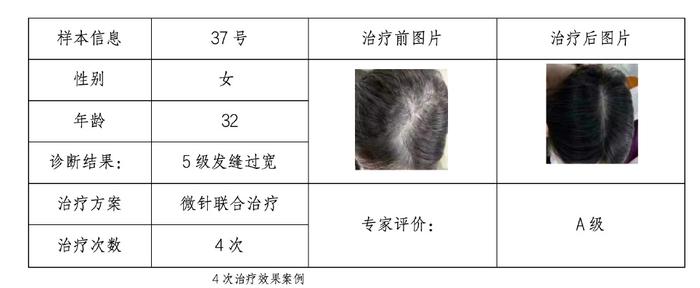 传统植发将被颠覆，微针疗法改善脱发获得临床实证